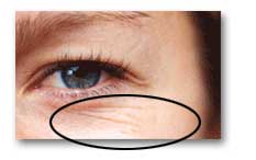 Ботокс (Botox) - это препарат, который вводится в определённые группы мышц для того, чтобы расслабить мимическую мускулатуру, т.к. с годами мимические мышцы приходят в состояние спазма и кожа под ними собирается в складки.