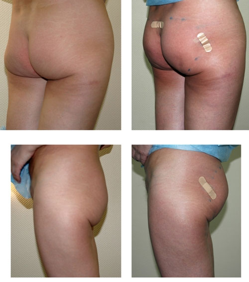 ���� Tissulift, � ������� �� ������� ����� � ����� Aptos, ��������� � �������-���������������� ����.